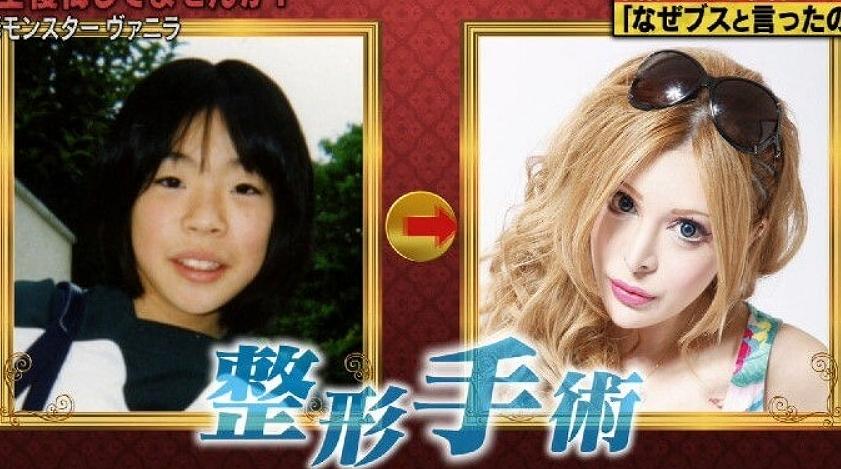 ヴァニラ,整形,ビフォーアフター