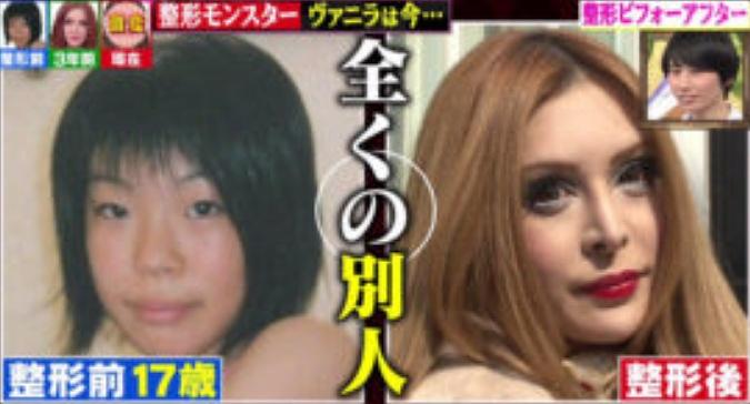 ヴァニラ,整形,ビフォーアフター